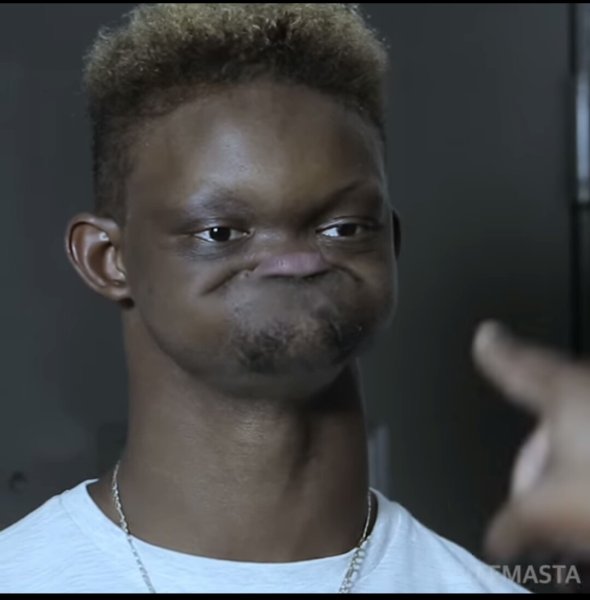 Чернокожий парень без челюсти