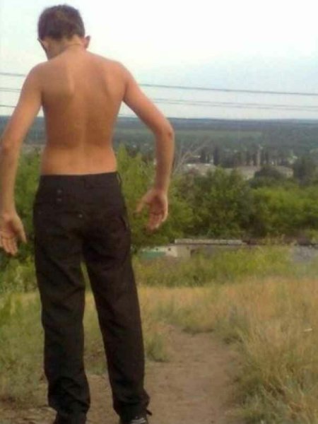 Синдром широкой спины