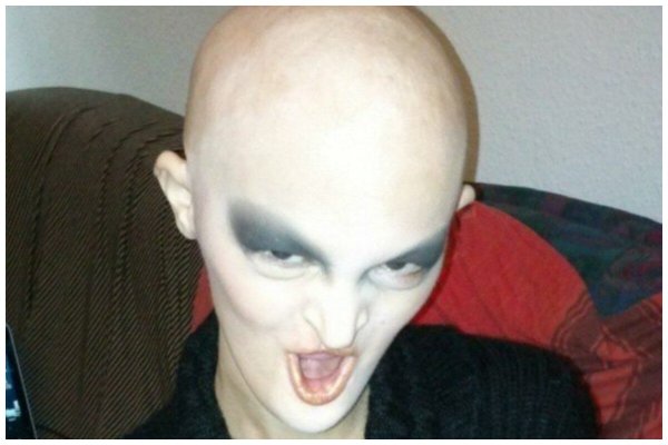 Ангидротическая эктодермальная дисплазия