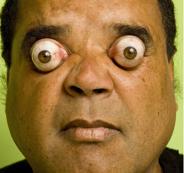 Ким Гудман- самые большие глаза в мире