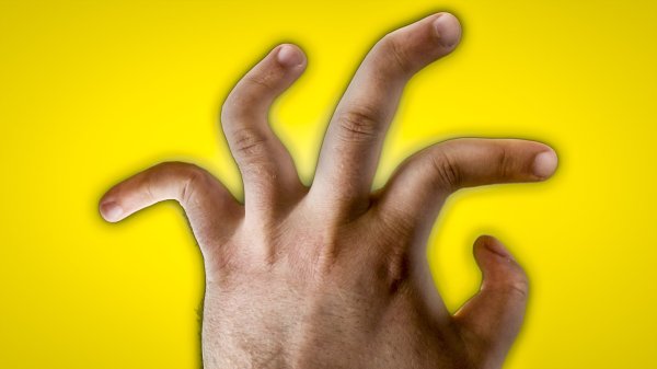 Руки с кривыми пальцами