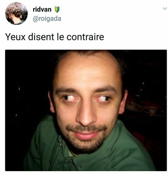 Косоглазие в разные стороны