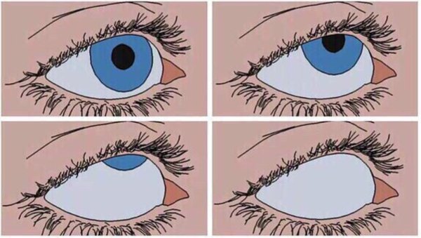 Зрачки закатываются вверх