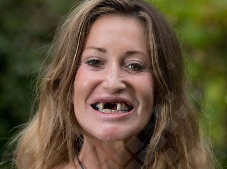 Женщина без передних зубов