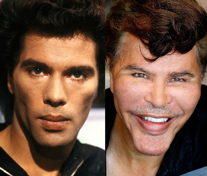 Игорь и Гришка Богдановы до и после пластики