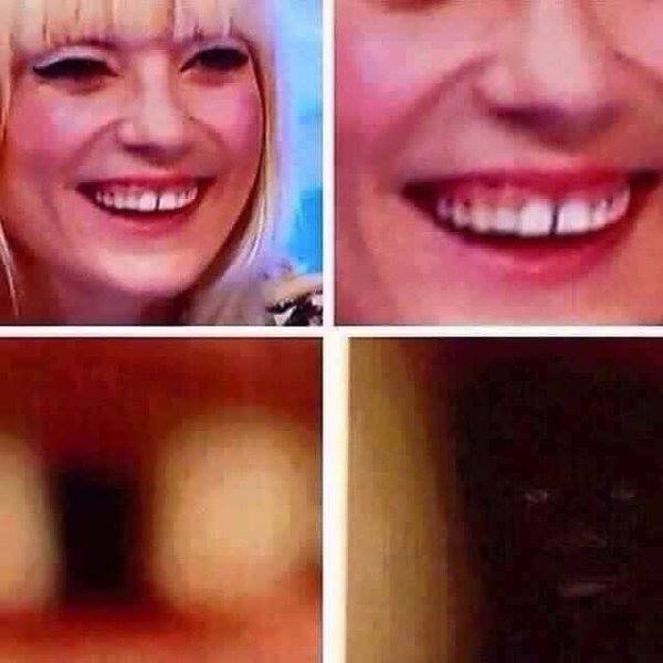 В щели между зубов человек паук