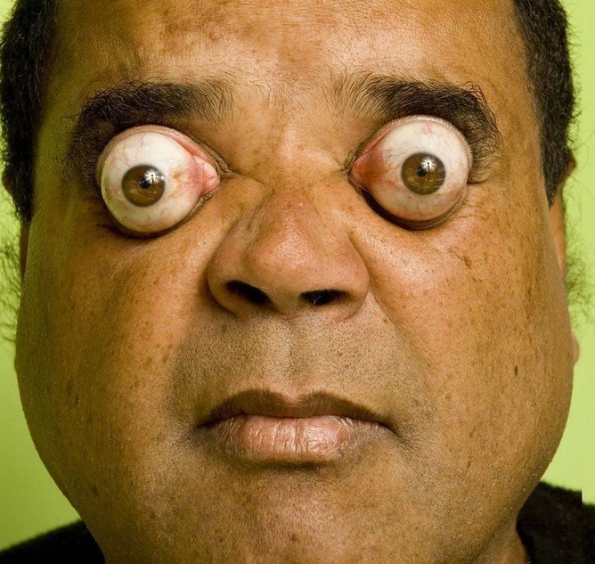 Ким Гудман- самые большие глаза в мире