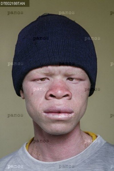 Узкоглазый негр альбинос