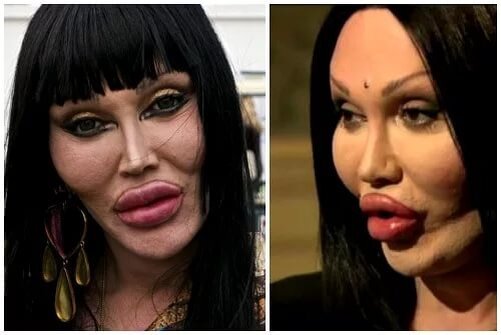 Пит Бернс фото до операции