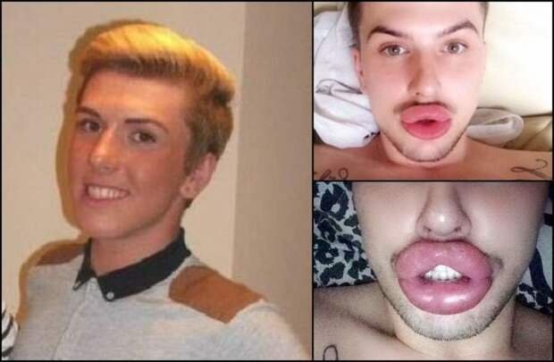 Мальчик с накаченными губами