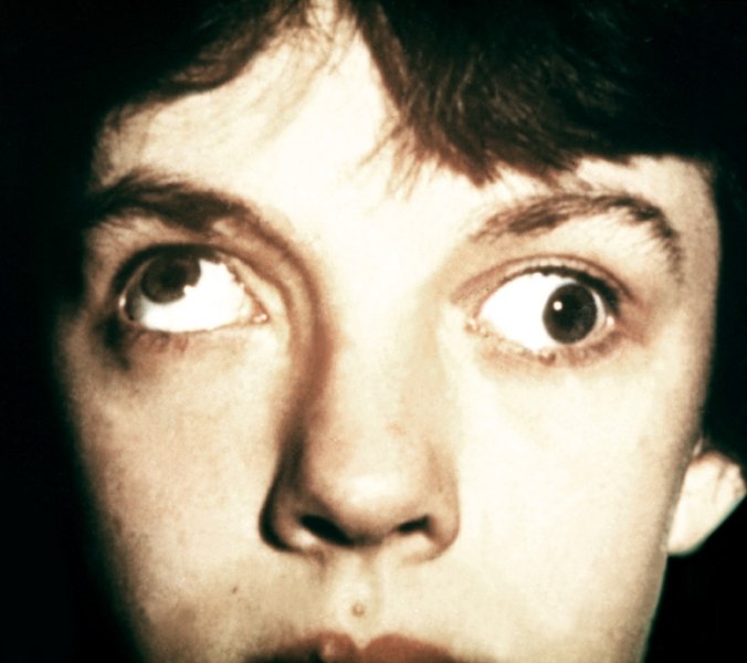 Сильное косоглазие