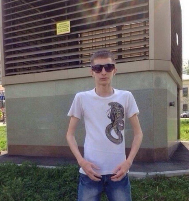 Синдром широкой спины