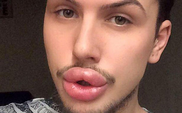 Мальчик с накаченными губами