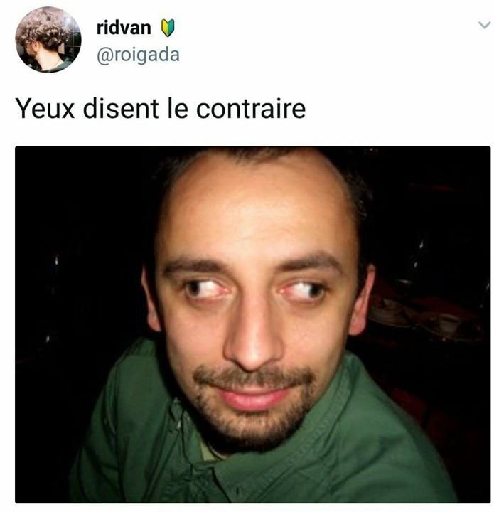 Косоглазие у мужчин