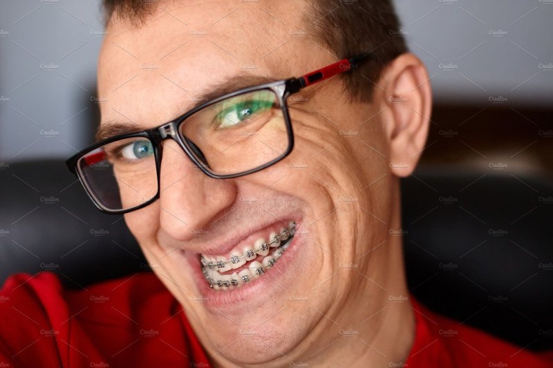 Улыбка с брекетами мужчина