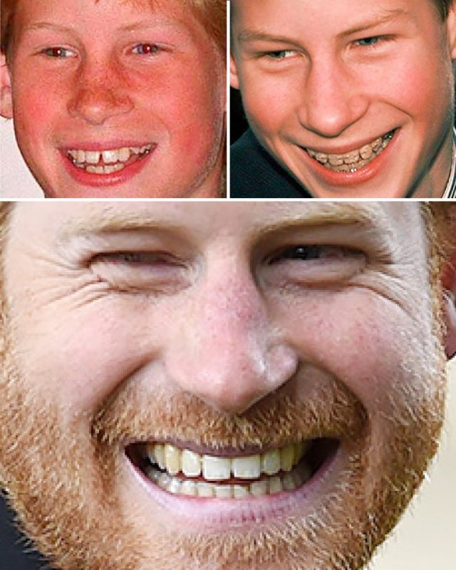 Люди с брекетами