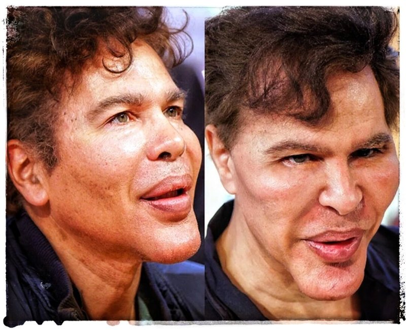 Братья Богдановы до и после пластики