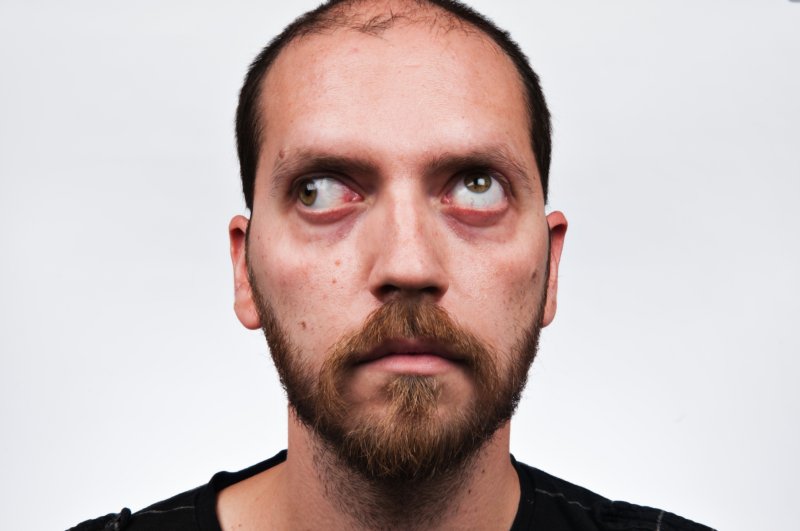 Сильное косоглазие