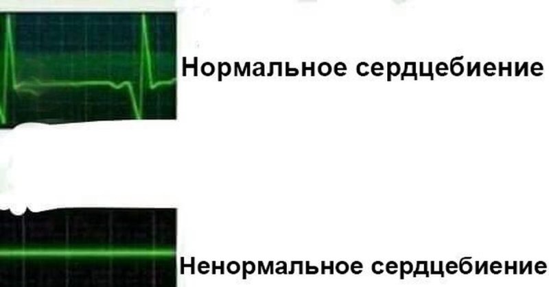 Ненормальное сердцебиение