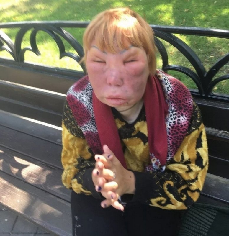 Адкащка с опухшими глазами