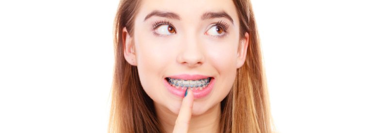 Металлические брекеты