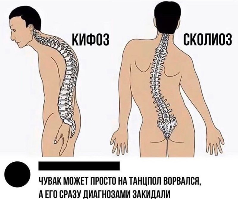 Сколиоз Мем