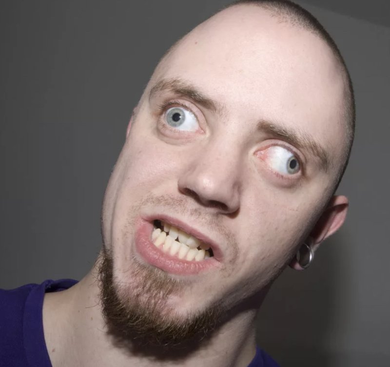 Косоглазый человек