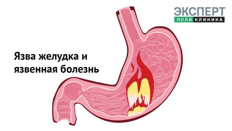 Рубцовая деформация луковицы 12 перстной кишки