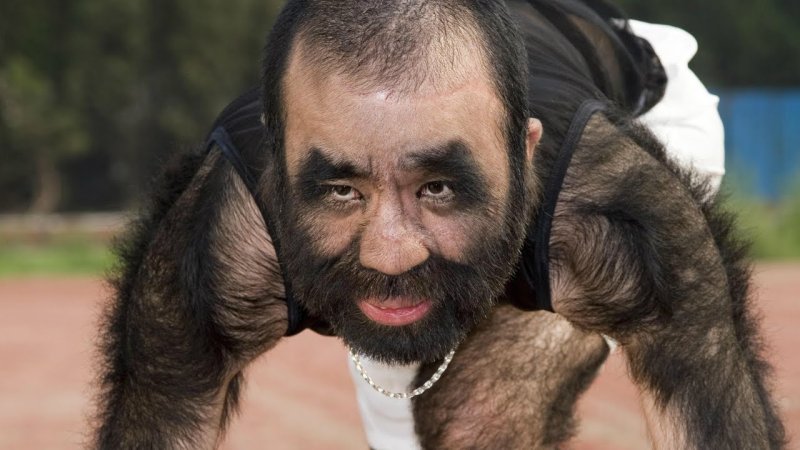 Синдром оборотня (гипертрихоз)