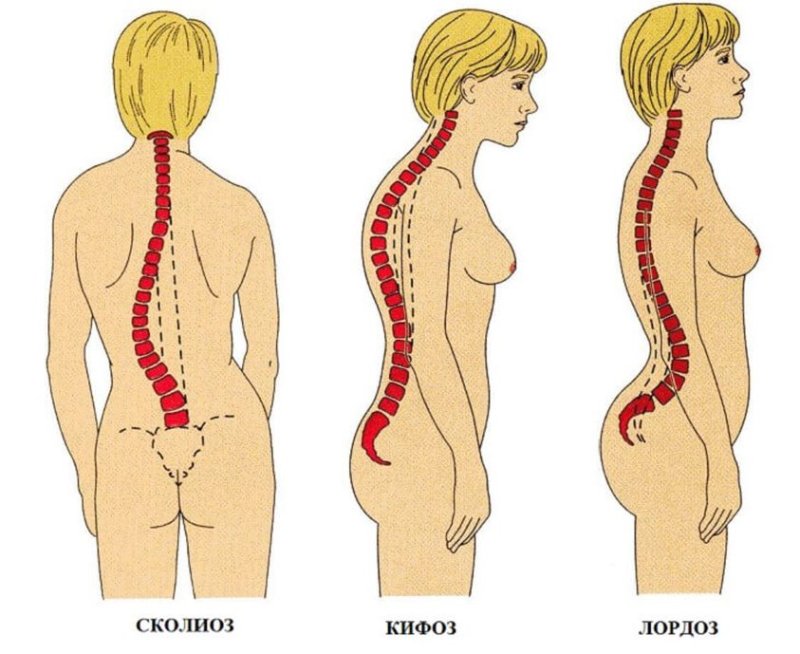 Степень искривления позвоночника кифоз